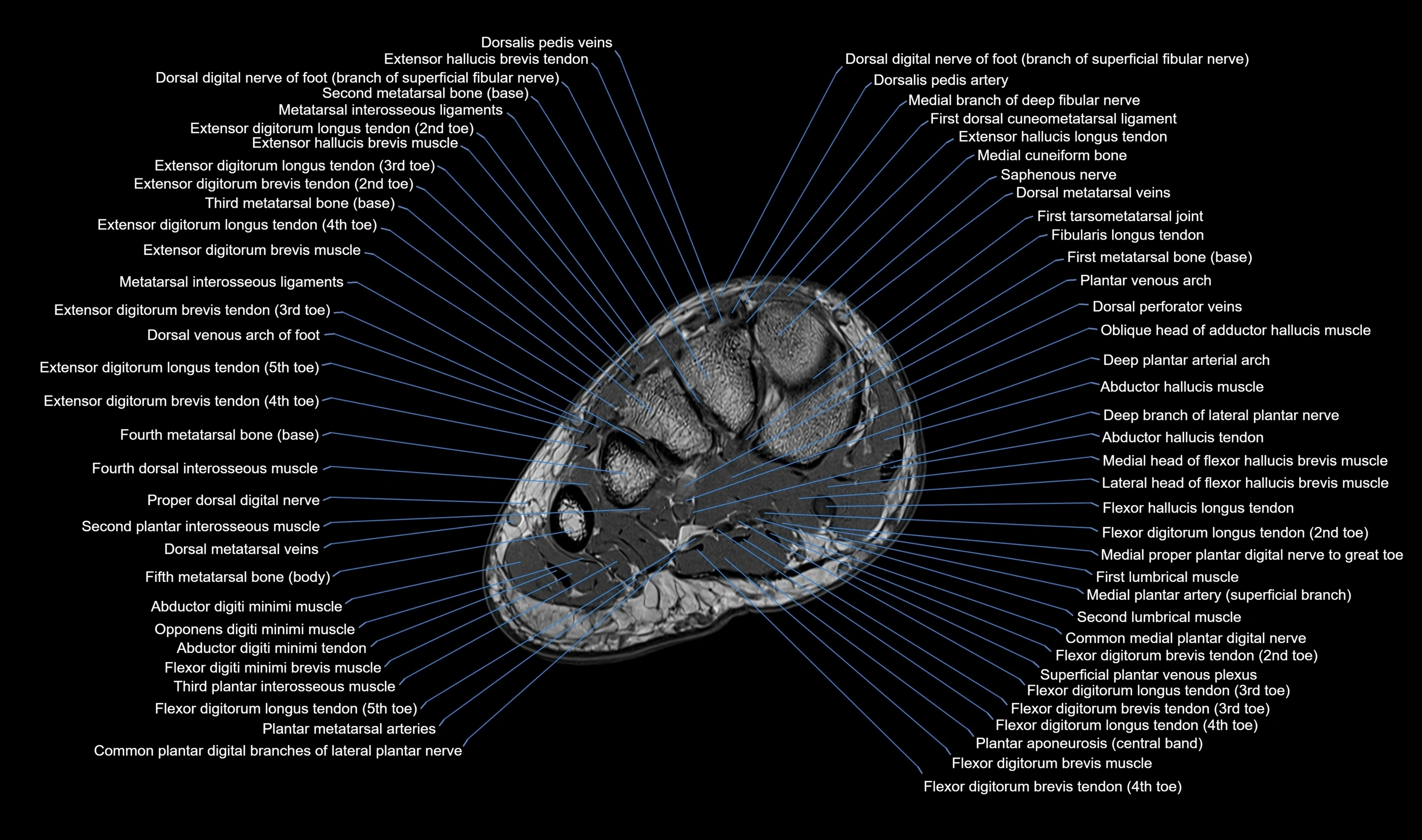 MRI mid foot axial cross sectional anatomy 3T  radiology  image-img-00001-00013.webp